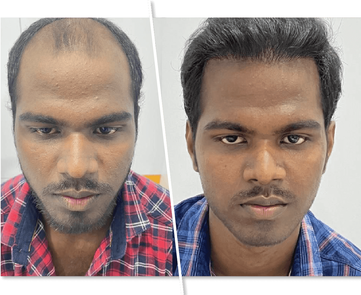 Hair-Transplantation_1.png