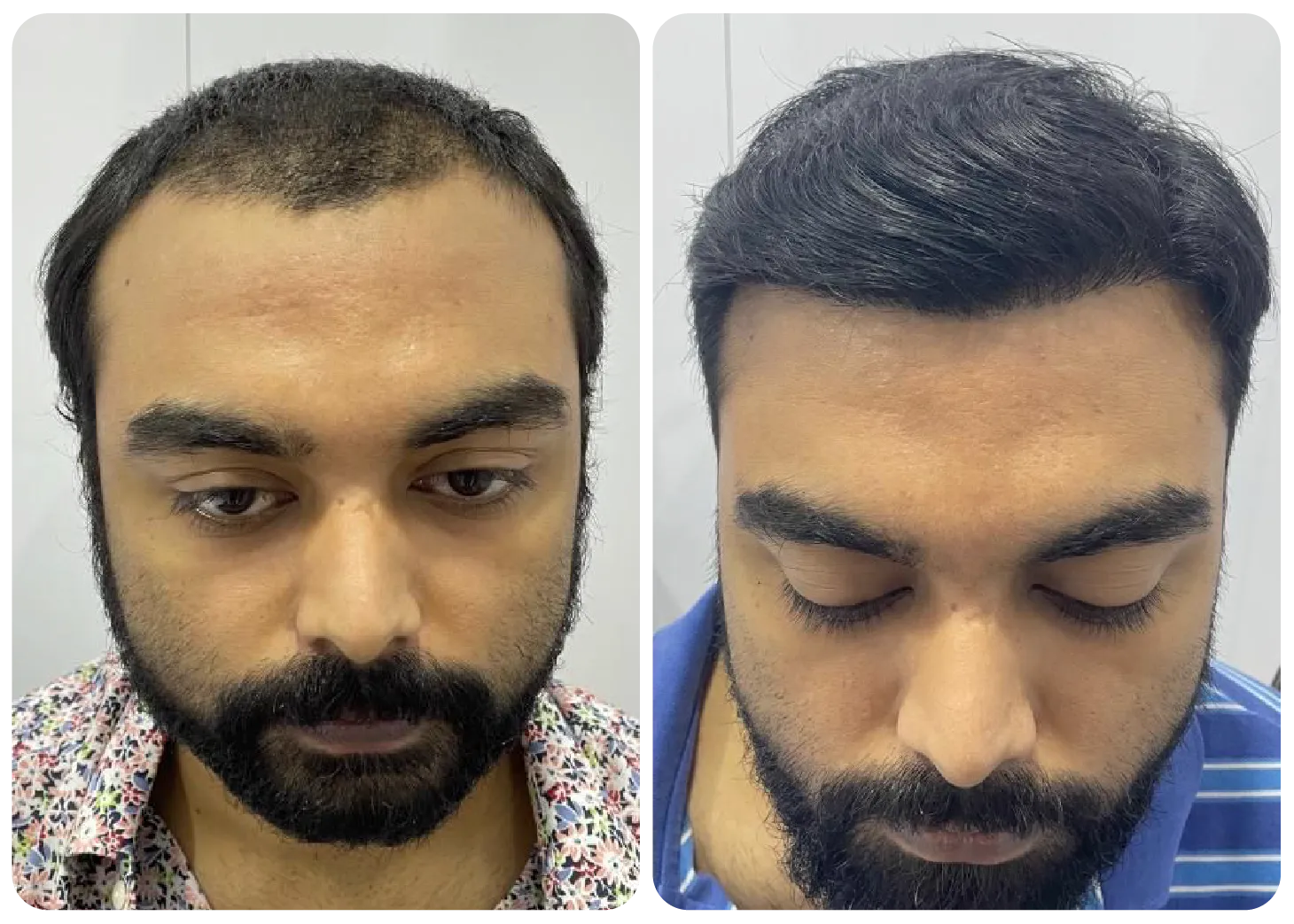 prp-hair-treatment-before-after-3.webp